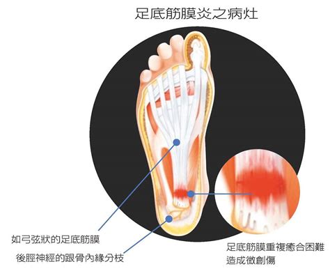 吱腳板底|足底筋膜炎